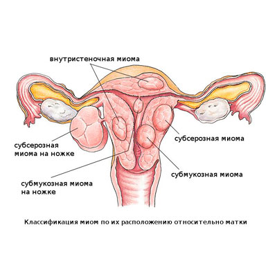 Лечение миомы матки