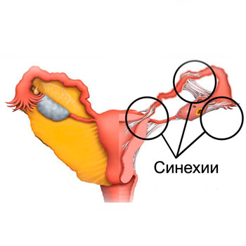 Хирургическое лечение внутриматочных патологий