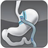 Mini-Gastric Bypass Mini-Gastric Bypass